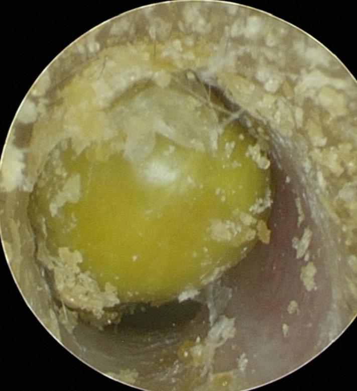 六一关爱,小孩子耳朵塞进异物视频