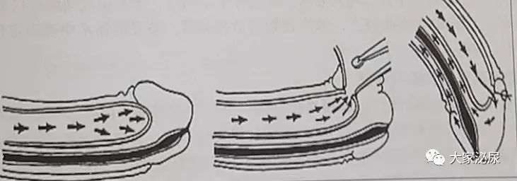干货│缺血型阴茎异常勃起的治疗