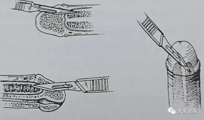 干货│缺血型阴茎异常勃起的治疗