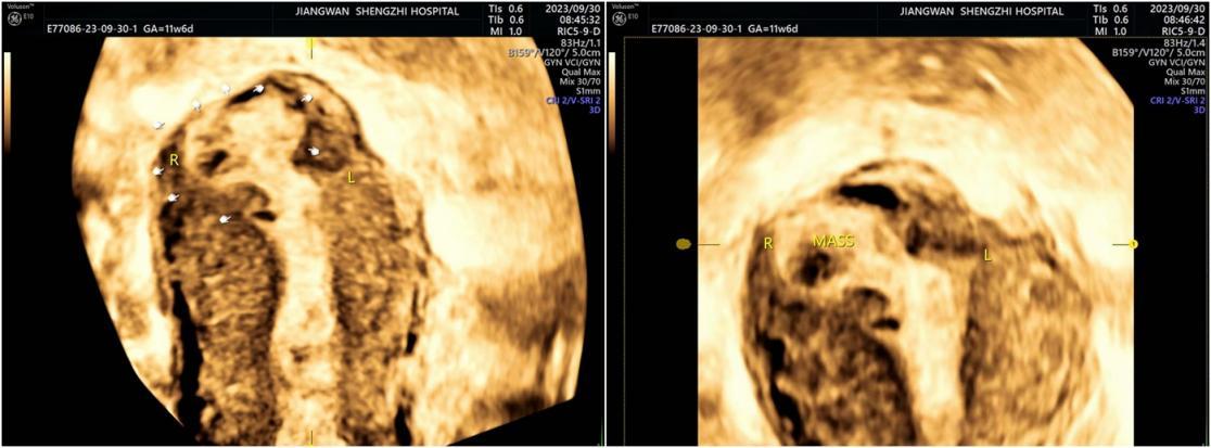 “火眼金睛”识病灶,江湾超声找到异位的“迷路宝宝”