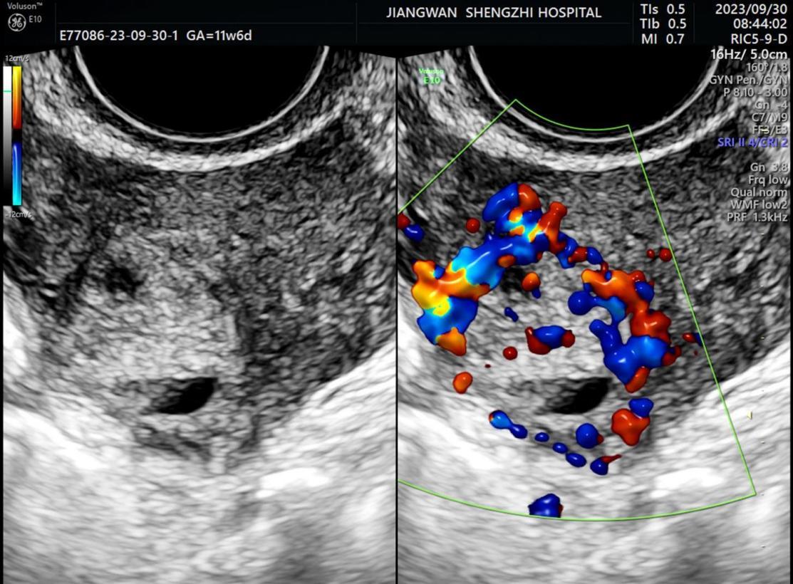 “火眼金睛”识病灶,江湾超声找到异位的“迷路宝宝”