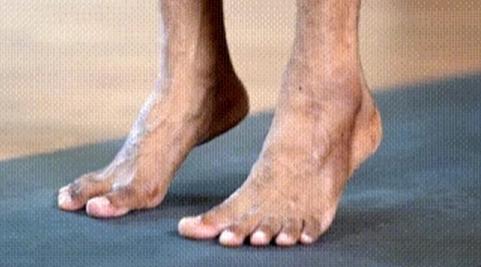 专家支招爱美女士，别让“水晶鞋”内的双脚受伤了