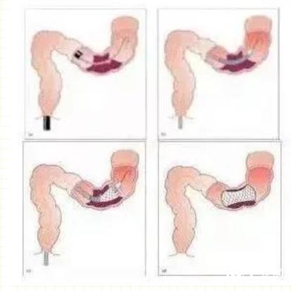 结肠肿瘤堵死了肠道怎么缓解,肿瘤引起的肠狭窄可以放支架吗